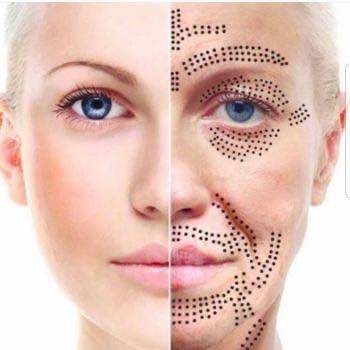 Formation Plasma Pen FROID OU CHAUD