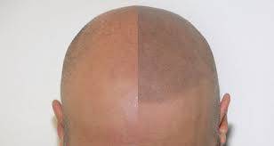 Formation tricopigmentation